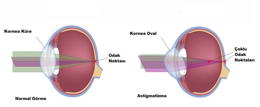astigmatizma nedir